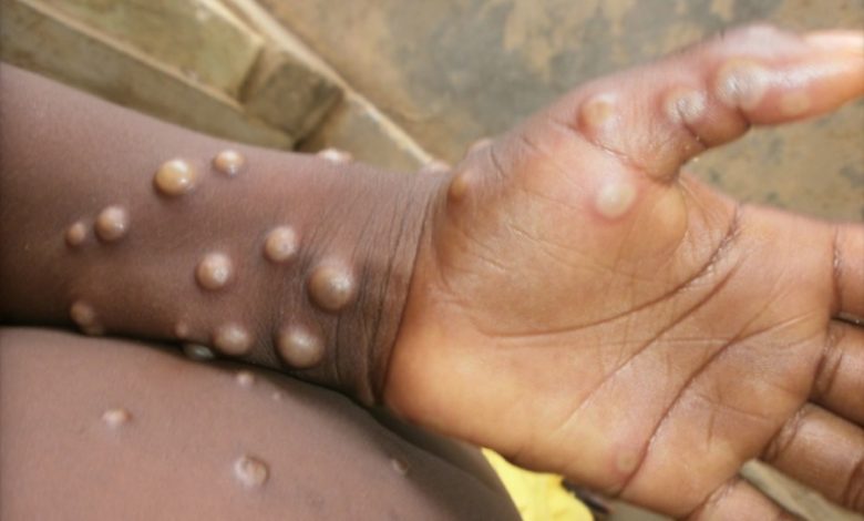 Mpox komt vooral voor in landen in West- en Centraal Afrika en veroorzaakt huiduitslag en griepachtige symptomen.